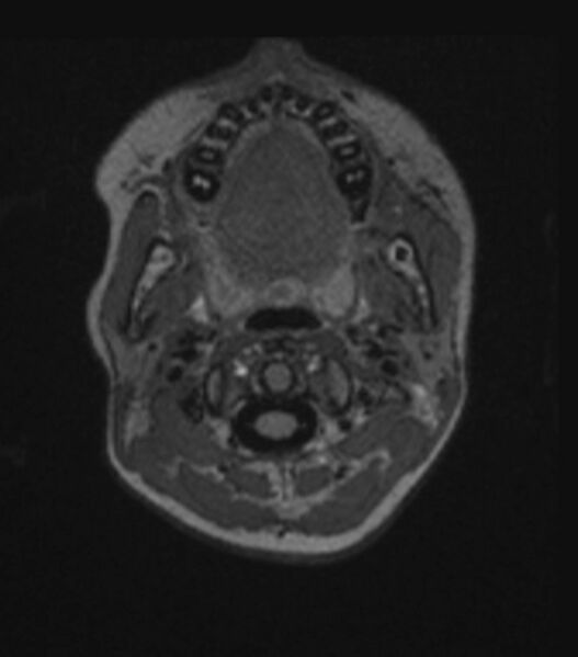 File:Choroid plexus carcinoma (Radiopaedia 91013-108553 Axial FLAIR C+ 52).jpg