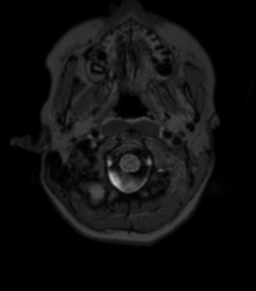 Choroid plexus carcinoma (Radiopaedia 91013-108553 Axial T2 fat sat 27).jpg