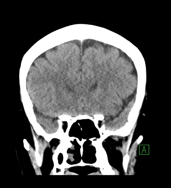 File:Choroid plexus xanthogranuloma (Radiopaedia 91271-108874 Coronal non-contrast 12).jpg