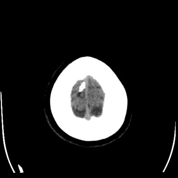 File:Chronic bilateral occipital lobe infarcts (Radiopaedia 31276-31996 Axial non-contrast 41).jpg