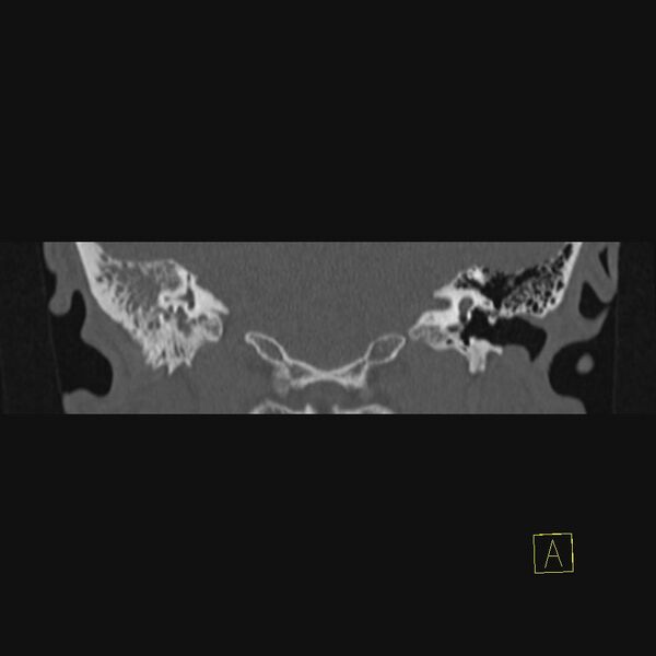 File:Chronic otitis media (Radiopaedia 14994-14912 Coronal bone window 4).JPEG