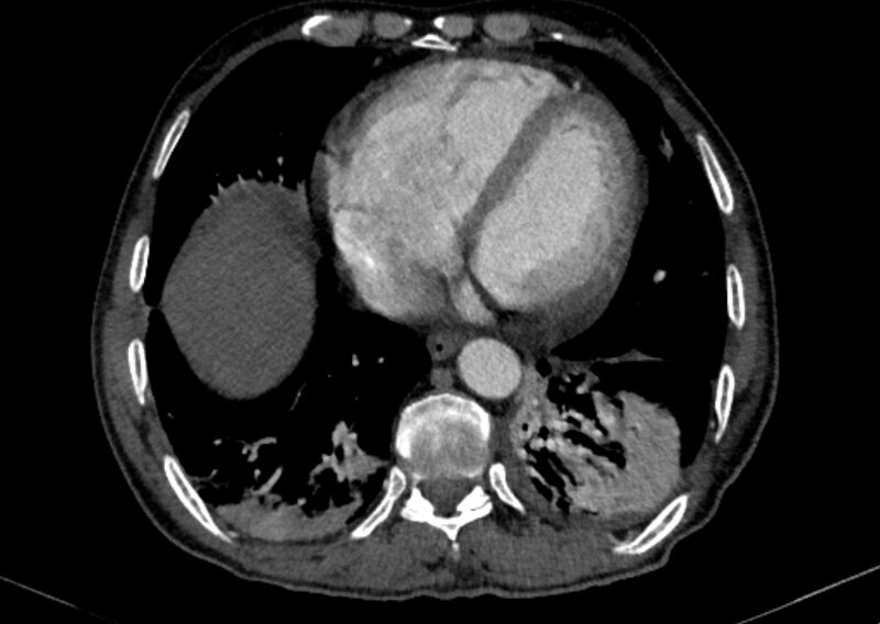 File:Chronic pulmonary embolism with bubbly consolidation (Radiopaedia 91248-108850 C+ arterial phase 112).jpg