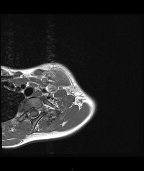 File:Chronic reactive multifocal osteomyelitis (CRMO) - clavicle (Radiopaedia 56406-63071 Axial T1 4).jpg