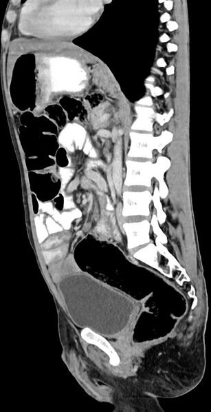 File:Chronic small bowel volvulus (Radiopaedia 75224-86322 C 67).jpg