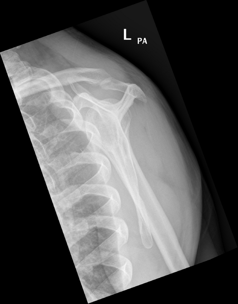 File:Clavicle and rib fractures (Radiopaedia 34975-36476 Lateral 1).png