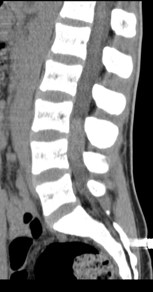 File:Clear cell meningoma - lumbar spine (Radiopaedia 60116-67691 A 21).png