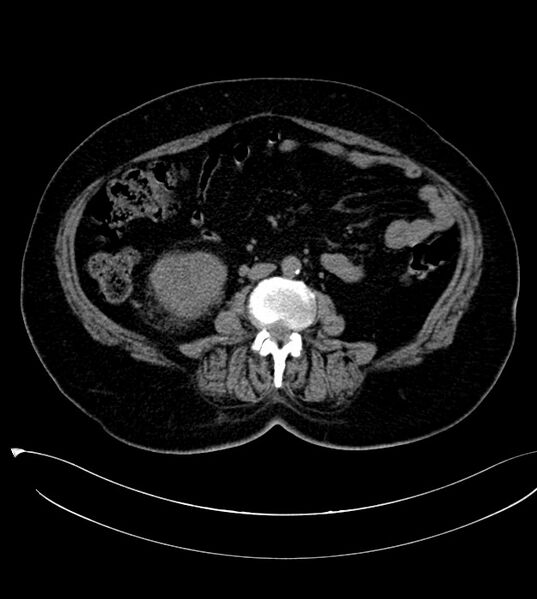 File:Clear cell renal cell carcinoma (Radiopaedia 85004-100537 Axial non-contrast 23).jpg