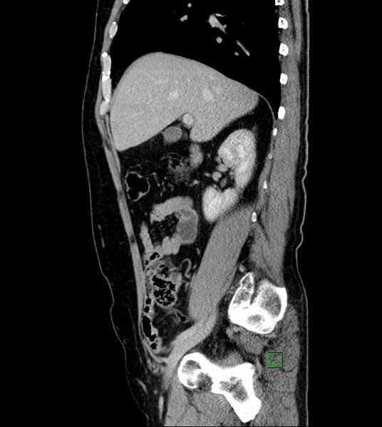 File:Clear cell renal cell carcinoma (Radiopaedia 85006-100539 G 42).jpg