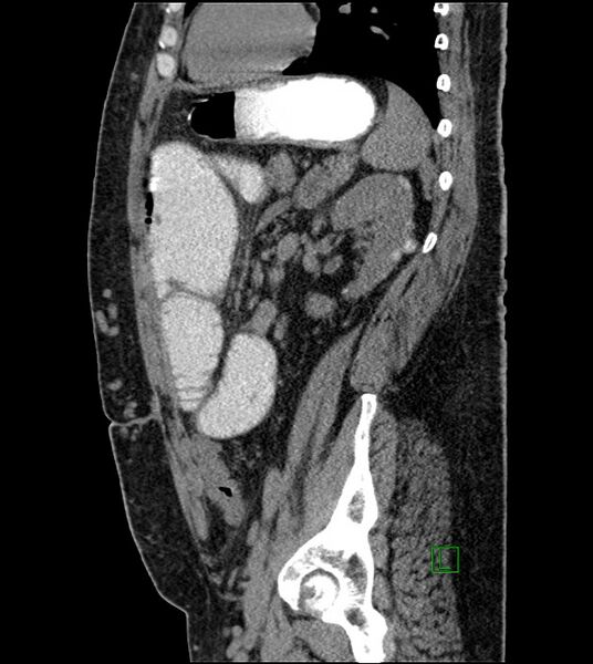 File:Closed-loop small bowel obstruction-internal hernia (Radiopaedia 78439-91096 C 54).jpg