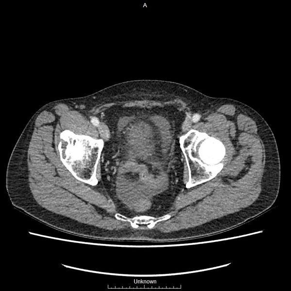 File:Closed loop bowel obstruction and ischemia (Radiopaedia 86959-103180 A 80).jpg