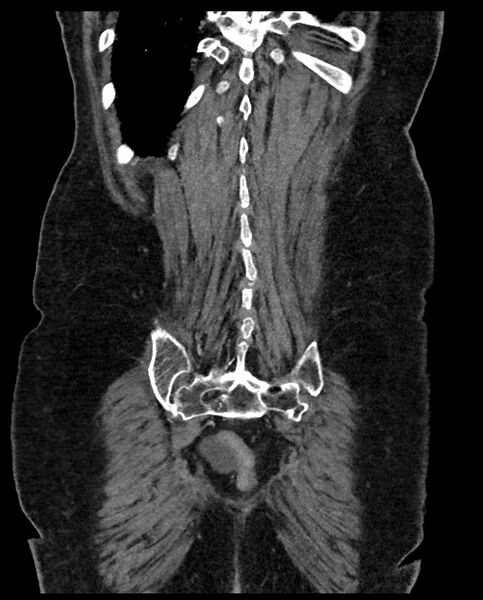 File:Closed loop small bowel obstruction - adhesions (Radiopaedia 59269-66611 B 109).jpg