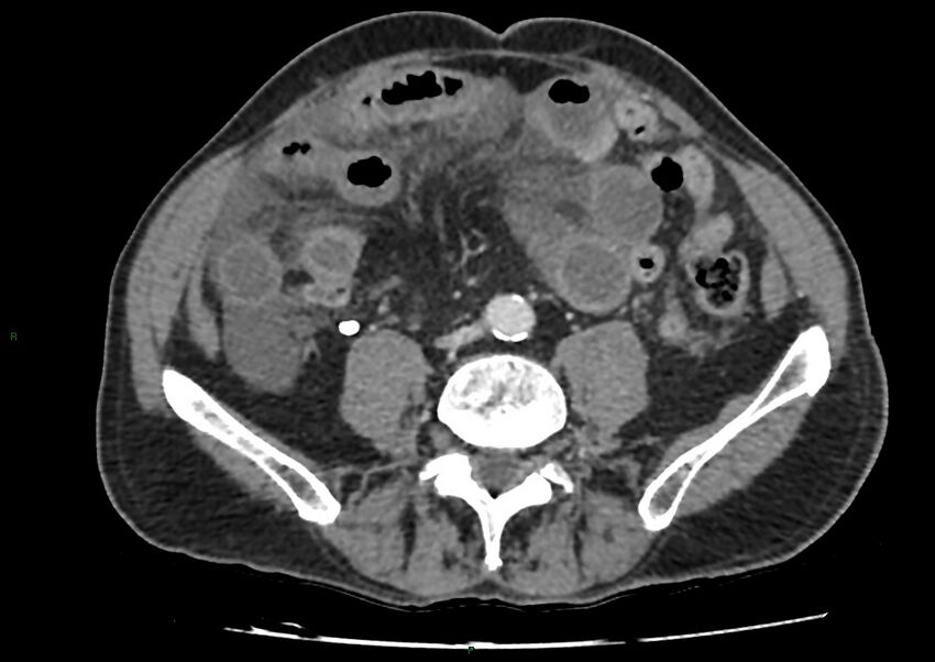 Closed loop small bowel obstruction with ischemia (Radiopaedia 84180-99456 A 73).jpg
