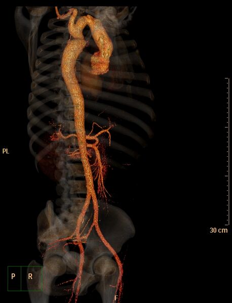 File:Coarctation of the aorta (Radiopaedia 49784-55050 3D VRT 9).jpg
