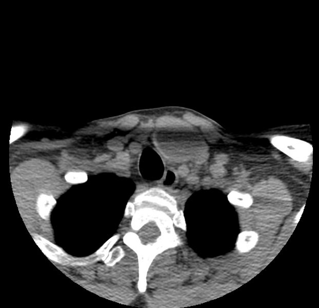 File:Colloid cyst of thyroid (Radiopaedia 22897-22923 Axial non-contrast 48).jpg