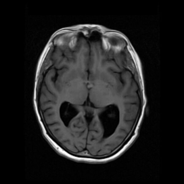 File:Colloid cyst with hydrocephalus (Radiopaedia 9373-10065 Axial T1 9).jpg