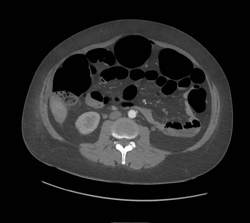 Colonic pseudo-obstruction (Radiopaedia 79752-92980 A 96).png