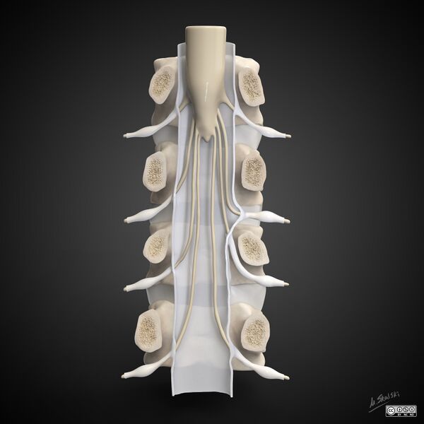 File:Conjoined nerve root - illustration (Radiopaedia 82144).jpg
