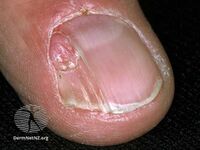 Periungal angiofibroma associated with tuberous sclerosis