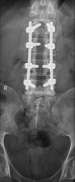 File:Lumbar laminectomy (x-ray) (Radiopaedia 62558).jpg