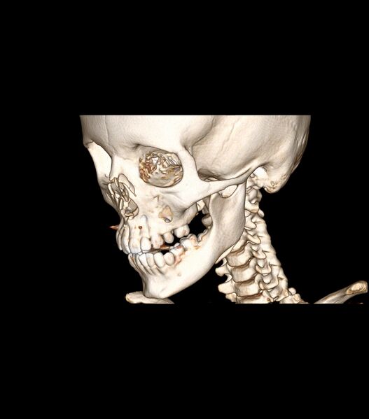 File:Nasoorbitoethmoid fracture (Radiopaedia 90044-107205 3D VRT 27).jpg