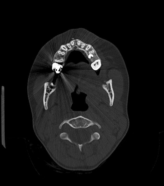 File:Nasoorbitoethmoid fracture (Radiopaedia 90044-107205 Axial bone window 44).jpg