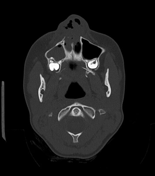 File:Nasoorbitoethmoid fracture (Radiopaedia 90044-107205 Axial bone window 53).jpg