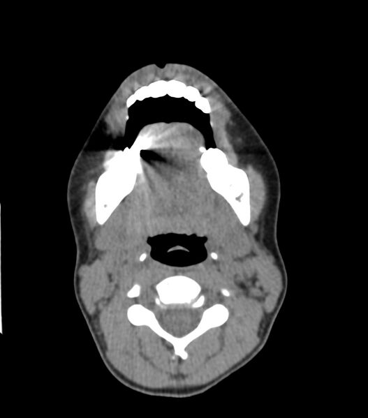File:Nasoorbitoethmoid fracture (Radiopaedia 90044-107205 Axial non-contrast 67).jpg