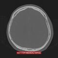 Nasopharyngeal carcinoma recurrence - skull base destruction (Radiopaedia 29107-29490 Axial bone window 36).jpg