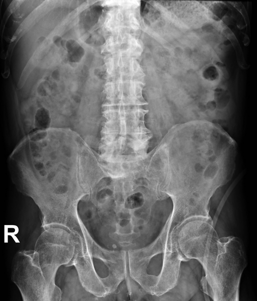 File:Neurogenic bladder with vesicoureteral reflux (Radiopaedia 90924-108431 Frontal 1).png