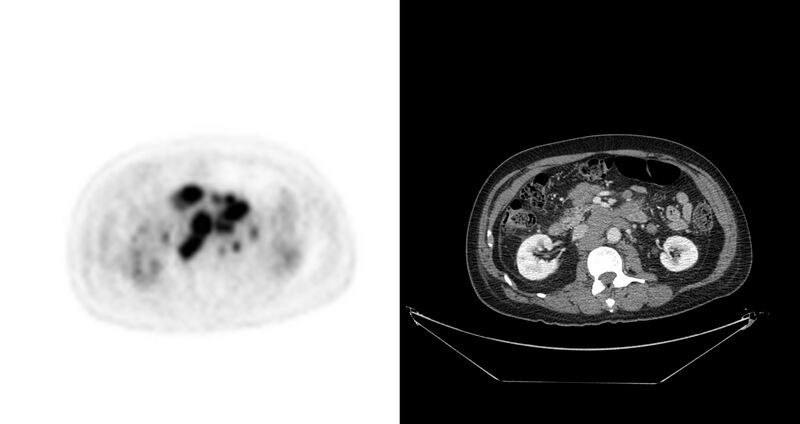 File:Non-Hodgkin lymphoma involving seminal vesicles with development of interstitial pneumonitis during Rituximab therapy (Radiopaedia 32703-33675 axial PET CT 29).jpg