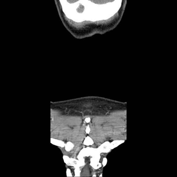 File:Normal CT of the neck (Radiopaedia 14575-14500 Coronal C+ 52).jpg