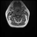 Normal cervical and thoracic spine MRI (Radiopaedia 35630-37156 Axial T1 22).png