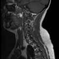 Normal cervical and thoracic spine MRI (Radiopaedia 35630-37156 Sagittal T1 11).png