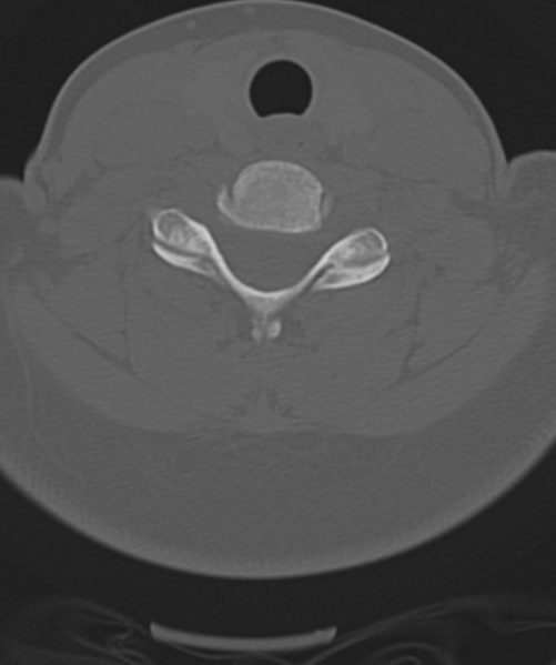 File:Normal cervical spine MRI (including Dixon) (Radiopaedia 42762-45926 Axial bone window 41).png