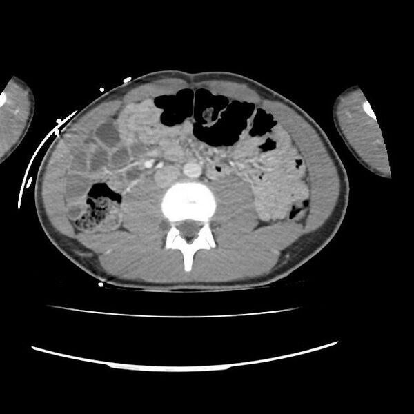 File:Normal dual-phase trauma CT chest,abdomen and pelvis (Radiopaedia 48092-52899 A 77).jpg