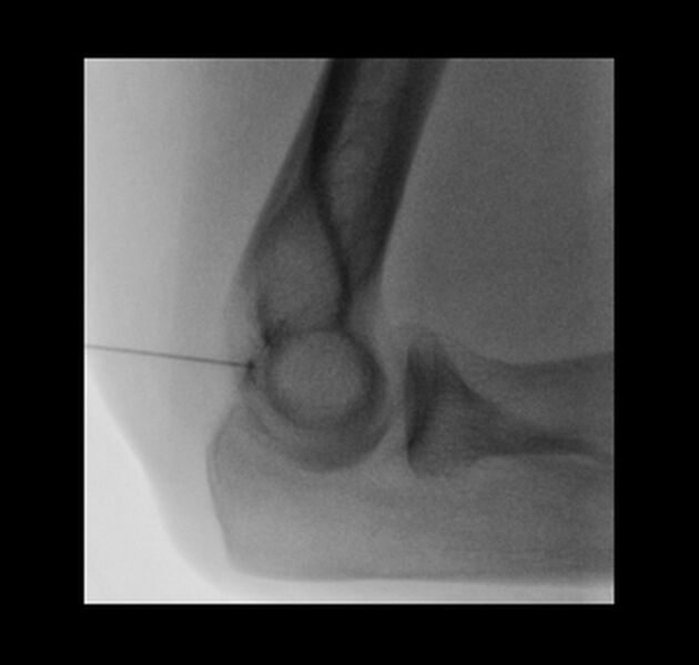 File:Normal elbow arthrograms (Radiopaedia 75550-86945 Lateral 4).jpg