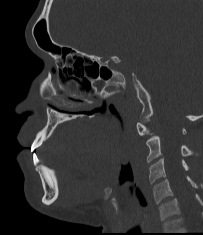Normal facial bone CT (Radiopaedia 88742-105476 Sagittal bone window 97).jpg