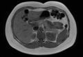 Normal liver MRI with Gadolinium (Radiopaedia 58913-66163 Axial T1 in-phase 19).jpg