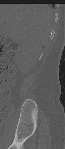 File:Normal lumbosacral CT (Radiopaedia 37923-39867 Sagittal bone window 96).png