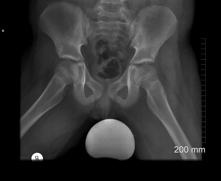 File:Normal pelvis x-ray - 9-year-old (Radiopaedia 53072-59033 Frog view 1).jpg