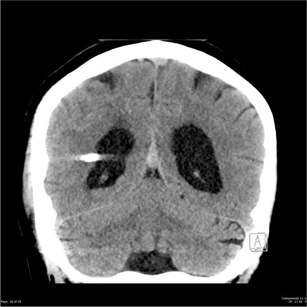 File:Normal pressure hydrocephalus (Radiopaedia 24415-24736 Coronal non-contrast 22).jpg