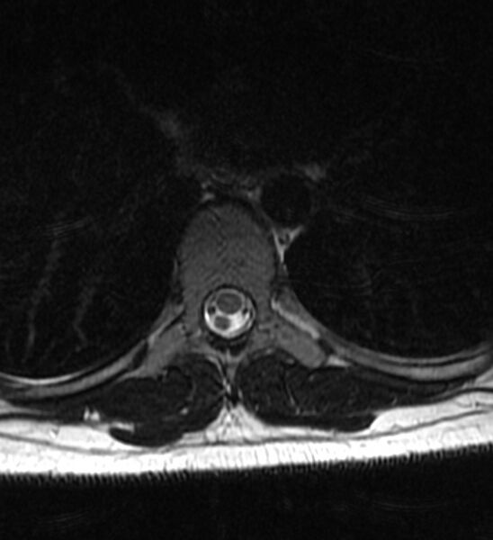 File:Normal thoracic spine MRI (Radiopaedia 41033-43781 Axial T2 4).jpg