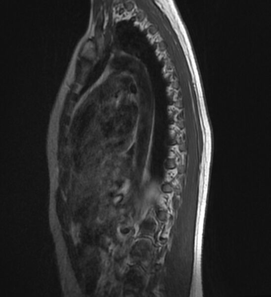 File:Normal thoracic spine MRI (Radiopaedia 41033-43781 Sagittal T1 12).jpg