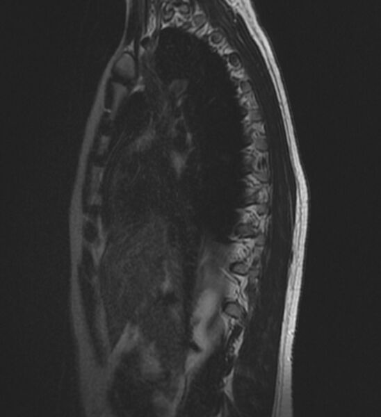 File:Normal thoracic spine MRI (Radiopaedia 41033-43781 Sagittal T2 2).jpg
