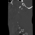 Normal trauma cervical spine (Radiopaedia 41017-43760 Sagittal bone window 4).png