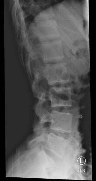 File:Normal trauma spine imaging (age 16) (Radiopaedia 45335-49357 C 1).jpg