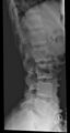 Normal trauma spine imaging (age 16) (Radiopaedia 45335-49357 C 1).jpg
