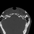 Occipital condyle fracture (Radiopaedia 31755-32691 Axial bone window 3).jpg