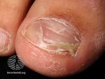 Onychomadesis following hand foot and mouth disease (DermNet NZ enteronailped1).jpg