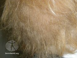 Woolly hair naevus (DermNet NZ hair-nails-sweat-woolly-hair-naevus3).jpg